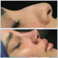 **جشنواره عمل زیبایی با قیمت‌های ویژه**|خدمات آرایشگری و زیبایی|شیراز, میرزاکوچک خان|دیوار