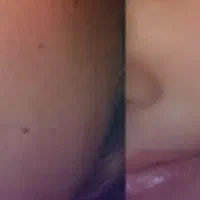 خال برداری با دستگاه پلاسما مانستر