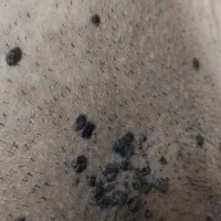 درمان تخصصی زگیل تناسلی