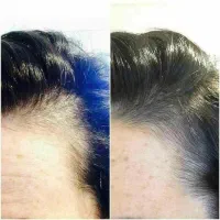 درمان ریزش مو ورشد مجدد مو|آرایشی، بهداشتی، درمانی|زنجان, |دیوار