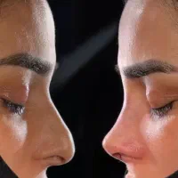 جراحی پلک وغبغب/نخ لیفت وکلاژن/فیلر/چربی/ژل ۴۹۰|خدمات آرایشگری و زیبایی|کرج, گوهردشت|دیوار