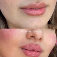 تزریق ژل لب بوتاکس زاویه سازی گونه فول فیس هایفو۲۴|خدمات آرایشگری و زیبایی|مشهد, احمدآباد|دیوار