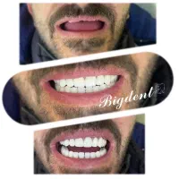 دندان مصنوعی تخفیف تا شب یلدا برای ۵ نفر قیمت ویژه|آرایشی، بهداشتی، درمانی|تبریز, |دیوار