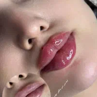 برداشتن خال،ژل،بوتاکس،انزیم،مزوکلنیک ایرانیان|خدمات آرایشگری و زیبایی|کرمانشاه, |دیوار