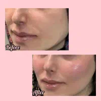 ژل بوتاکس|خدمات آرایشگری و زیبایی|سبزوار, امیر کبیر|دیوار