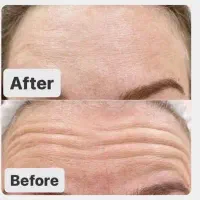 تخفیف تخفیف بوتاکس با بهترین روش روز دنیا