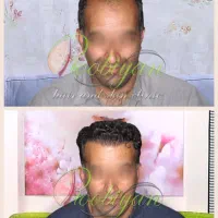 کاشت فوق تخصصی مو‌  سر. ، ریش ، ابرو