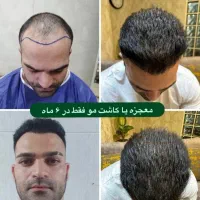 ۵۰٪تخفیف کاشتمو در شیراز|خدمات آرایشگری و زیبایی|خرم‌آباد, |دیوار