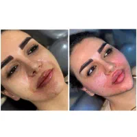 تزریق تخصصی فیلروبوتاکس و آنزیم توسط پزشک|خدمات آرایشگری و زیبایی|کرمانشاه, |دیوار