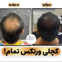 شبیه سازی فولیکول مو smp اس کالپ