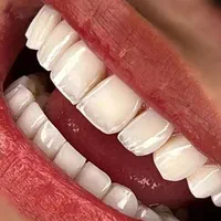 آموزش تخصصی صفرتاصد کامپوزیت ونیر ولیرینگ