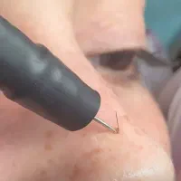 درمان تخصصی لک و کک و مک|خدمات آرایشگری و زیبایی|ساری, |دیوار