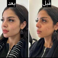 تزریقات ژل بوتاکس..  کاشت ابرو .ومو|خدمات آرایشگری و زیبایی|اسلام‌شهر, باغ فیض|دیوار