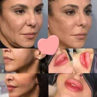 قبل از بوتاکس، فیلر، مزو، prp این اگهی رو بخون