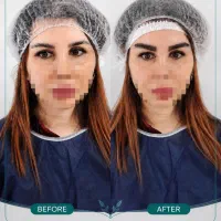 کاشت ابرو با تخفیف تکرارنشدنی