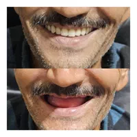 دندانسازی(بلوارهدایت)دندان مصنوعی/دندان سازی|خدمات آرایشگری و زیبایی|مشهد, هدایت|دیوار