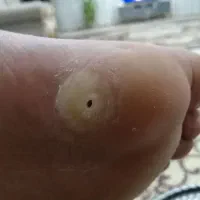 برداشتن خال زیگیل ومیخچه دست پابامحلول گیاهی