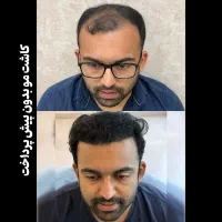 کاشت مو و ابرو قسطی ۳تومن