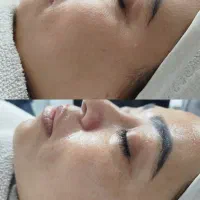 فیشیال تخصصی پوست جوانسازی رو روشن سازی