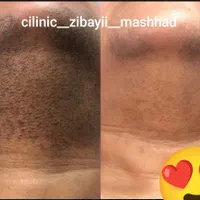 لـیزر موهای زائد/الکساندرایت/پی ار پی/پاککردن تاتو|خدمات آرایشگری و زیبایی|مشهد, آزادشهر|دیوار