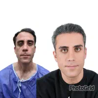 کاشت موی وی آی پی ، تضمینی و اقساطی