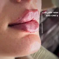 جشنواره پی آرپی ژل و بوتاکس مزوتراپی بلفارو|خدمات آرایشگری و زیبایی|اهواز, کیانپارس |دیوار