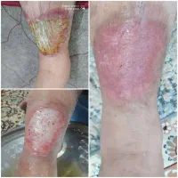 کارشناس تخصصی زخم و استوما|خدمات آرایشگری و زیبایی|قم, زنبیل آباد|دیوار