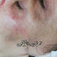 درمان عارضه پوستی درساوه