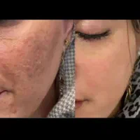 سالن ایران دخت( رفع جوش.جای جوش .کک ومک