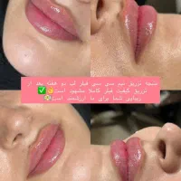 مطب زیبایی لیزر بوتاکس ژل مزو نخ لک جوش|خدمات آرایشگری و زیبایی|لردگان, |دیوار