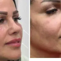 تزریق ژل و فیلر بوتاکس