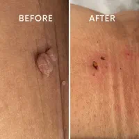 رفع ریشه ای زگیل و تبخال