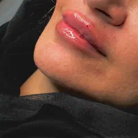 مطب تزریق ژل لب تخفیف فیلر لیفت صورت بوتاکس