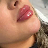 تزریق ژل بوتاکس لیزر هایفو مزو پی ار پی نخ فیشیال|خدمات آرایشگری و زیبایی|شهریار, |دیوار