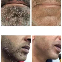 برداشت خال زگیل خالگوشتی میخچه کک مک
