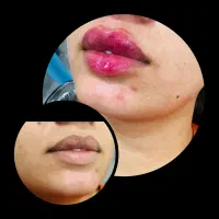 ژل و بوتاکس