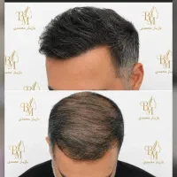میکروپیگمنتیش مو