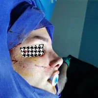 جراحی بینی عمل بینی انواع جراحی زیبایی|خدمات آرایشگری و زیبایی|ساری, |دیوار