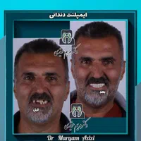 پایتخت ایمپلنت دندان دندانپزشکی تضمینی تعرفه دولتی|خدمات آرایشگری و زیبایی|شیراز, معالی‌آباد|دیوار