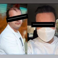 استخدام ویزیتور با پورسانت بالا در حوزه کاشت مو|استخدام بازاریابی و فروش|تهران, سعادت‌آباد|دیوار