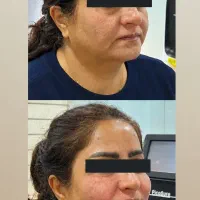 جوانسازی و فرم دهی صورت با بایوفیلر اتولوگ