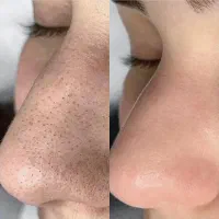 مدل فشیال و پاکسازی پوست بصورت حرفه ای|خدمات آرایشگری و زیبایی|مشهد, زیبا شهر|دیوار