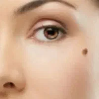 برداشتن خال سطحی،زگیل و منگوله مخصوص بانوان