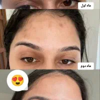 ماسک وصابون کربن ضدجوش