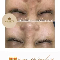 فیشال،آلگاپیل(پوست مار)هایفوتراپی،پوست کره ای|خدمات آرایشگری و زیبایی|قم, دورشهر|دیوار