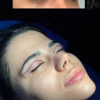 بلفاروپلاستی،چربی صورت،لیفت ابرو