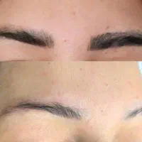 تخفیف لیزر حذف تتو پترو ازاد