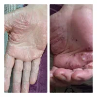 درمان صدرصدی  بیماری های پوستی