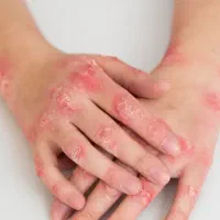 هنوز با خارش و پوسته‌ریزی دست‌وپنجه نرم می‌کنید