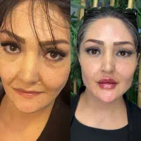 فیلر لب و بوتاکس با پنجاه درصد تخفیف|خدمات زیبایی و سلامت|تهران, صادقیه|دیوار
